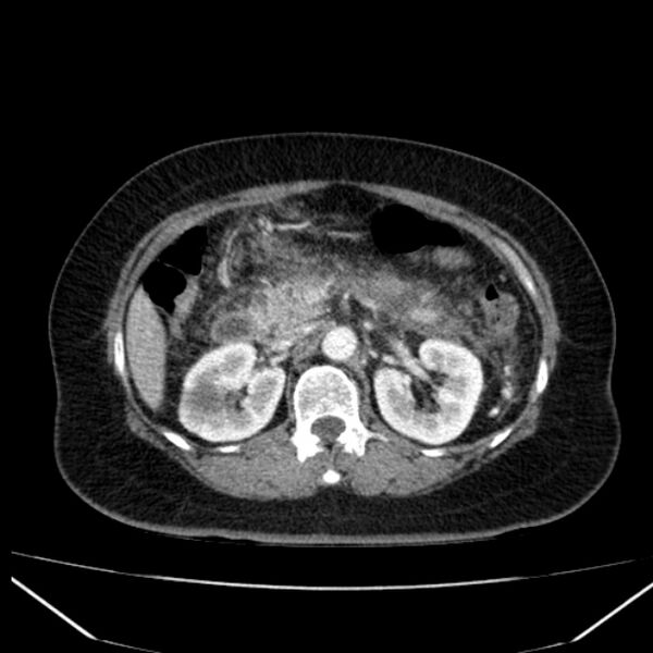 File:Acute pancreatitis - Balthazar C (Radiopaedia 26569-26714 Axial C+ arterial phase 34).jpg