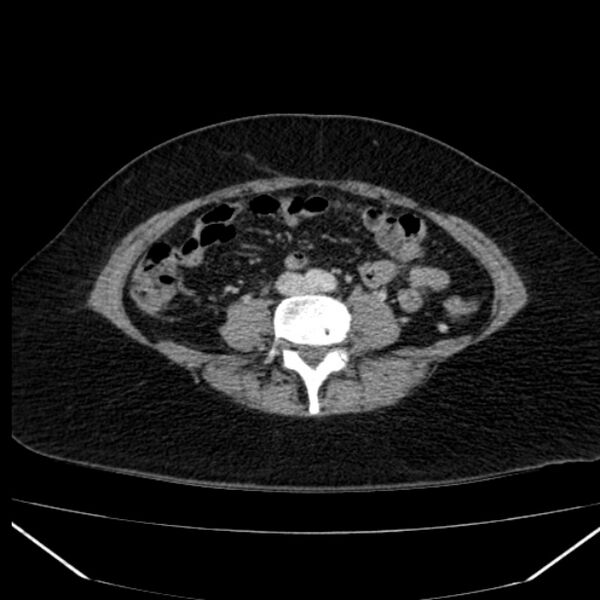 File:Acute pancreatitis - Balthazar C (Radiopaedia 26569-26714 Axial C+ portal venous phase 62).jpg