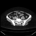 Acute pancreatitis - Balthazar C (Radiopaedia 26569-26714 Axial C+ portal venous phase 72).jpg