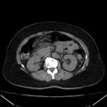 Acute pancreatitis - Balthazar C (Radiopaedia 26569-26714 Axial non-contrast 42).jpg