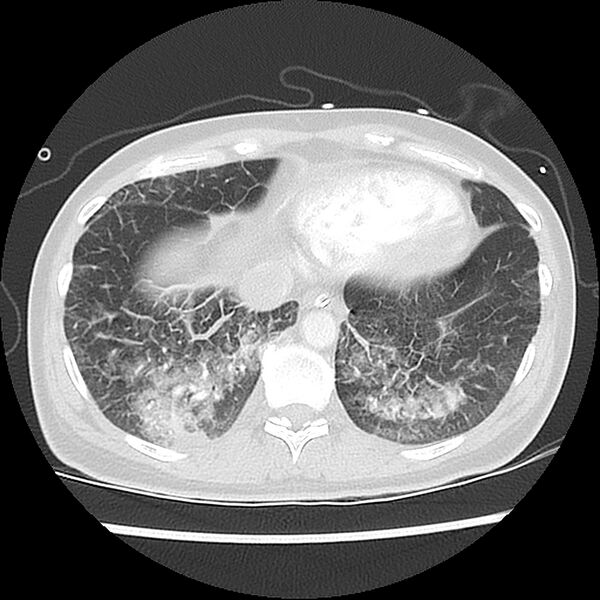 File:Acute pulmonary edema on CT (Radiopaedia 33582-34672 Axial lung window 43).jpg