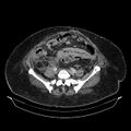 Acute pyelonephritis (Radiopaedia 25657-25837 Axial renal parenchymal phase 56).jpg