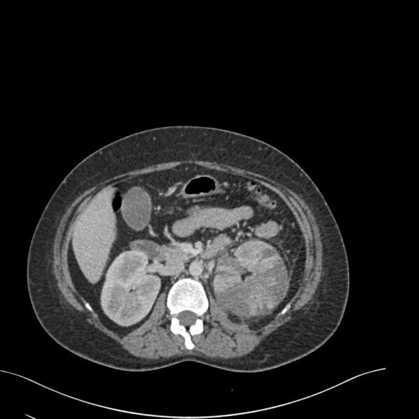 File:Acute pyelonephritis with renal vein thrombosis (Radiopaedia 58020-65053 Axial renal parenchymal phase 58).jpg