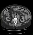 Acute renal failure post IV contrast injection- CT findings (Radiopaedia 47815-52557 Axial non-contrast 36).jpg
