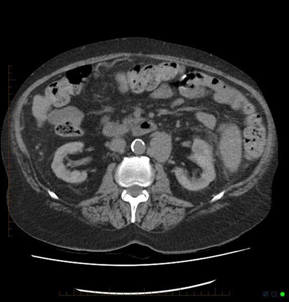 File:Acute renal failure post IV contrast injection- CT findings (Radiopaedia 47815-52557 Axial non-contrast 36).jpg