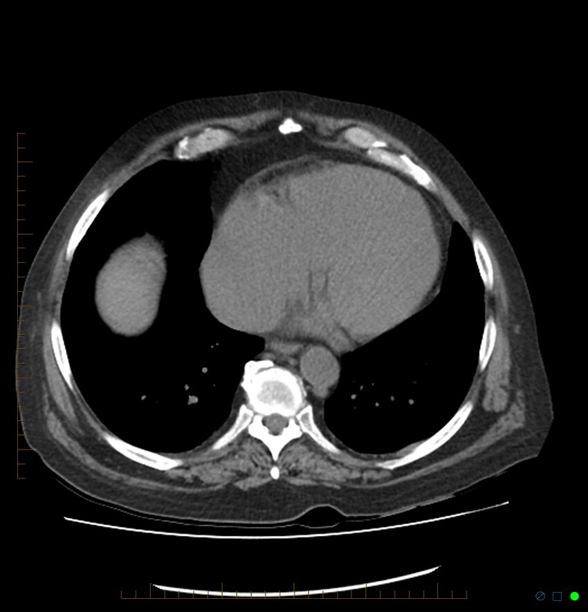 Acute renal failure post IV contrast injection- CT findings (Radiopaedia 47815-52557 Axial non-contrast 6).jpg