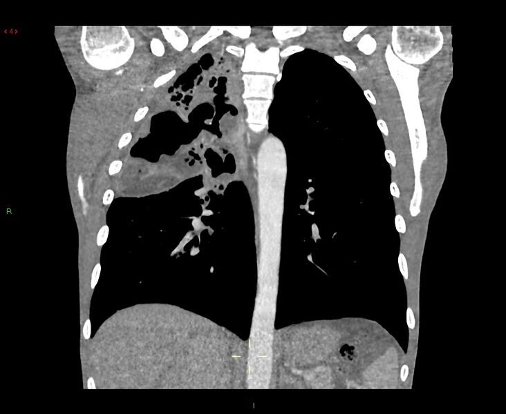 File:Acute right lung abscess (Radiopaedia 34806-36258 Coronal C+ arterial phase 21).jpg