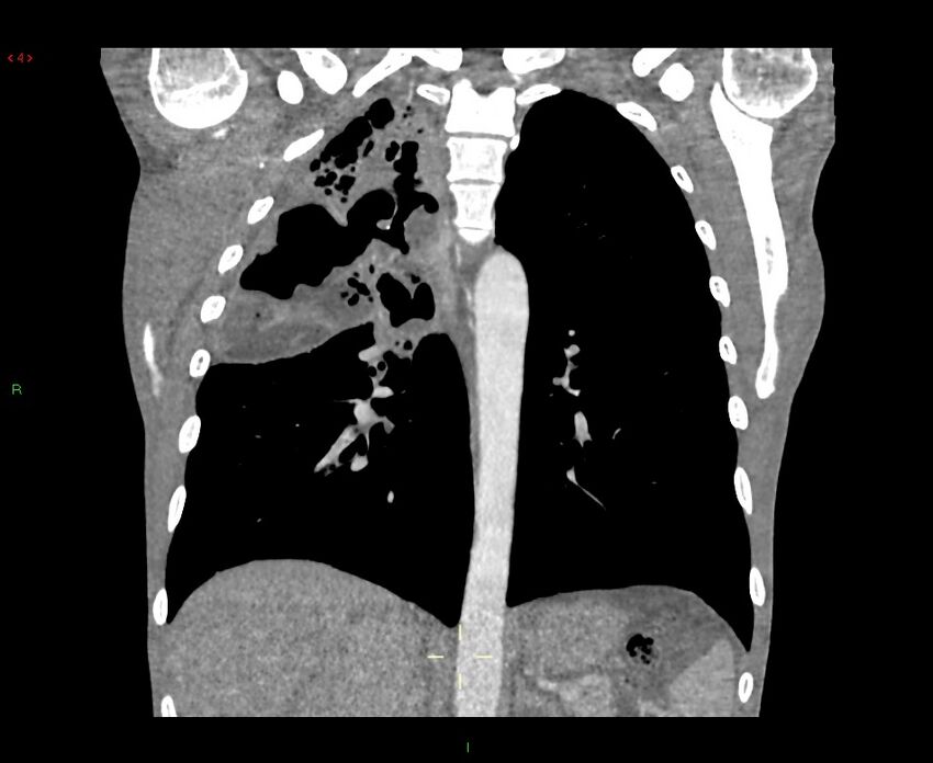 Acute right lung abscess (Radiopaedia 34806-36258 Coronal C+ arterial phase 21).jpg