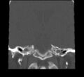 Acute sinusitis (Radiopaedia 23161-23215 Coronal bone window 61).jpg
