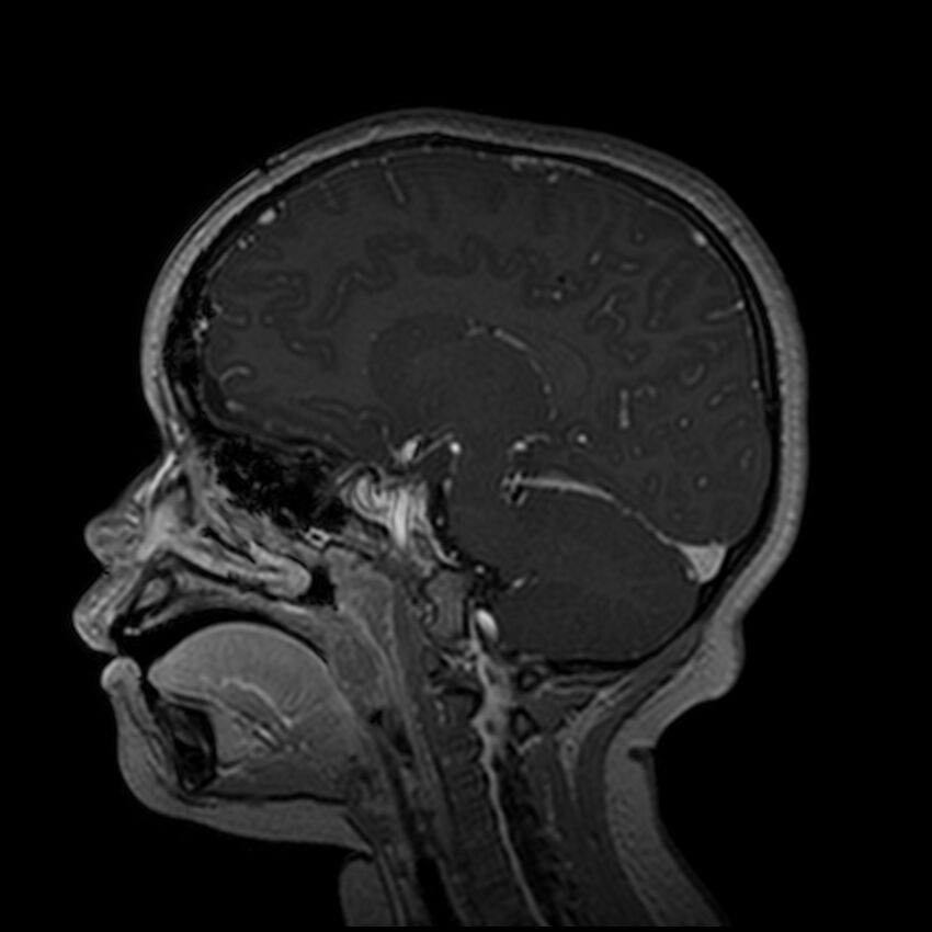 Adamantinomatous craniopharyngioma (Radiopaedia 77407-89529 H 70).jpg