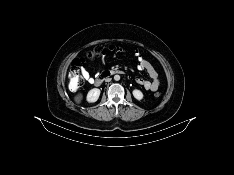 File:Adenocarcinoma of pancreas with hepatic metastasis (Radiopaedia 64332-73122 Axial C+ delayed 49).jpg