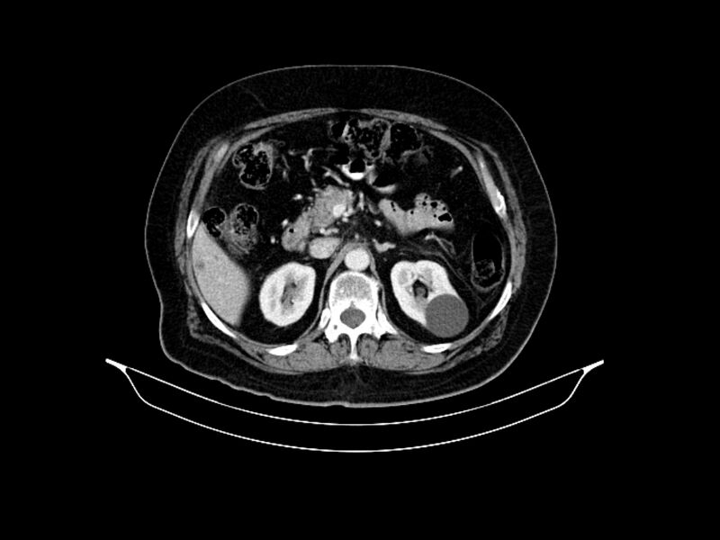 File:Adenocarcinoma of pancreas with hepatic metastasis (Radiopaedia 64332-73122 Axial C+ portal venous phase 75).jpg