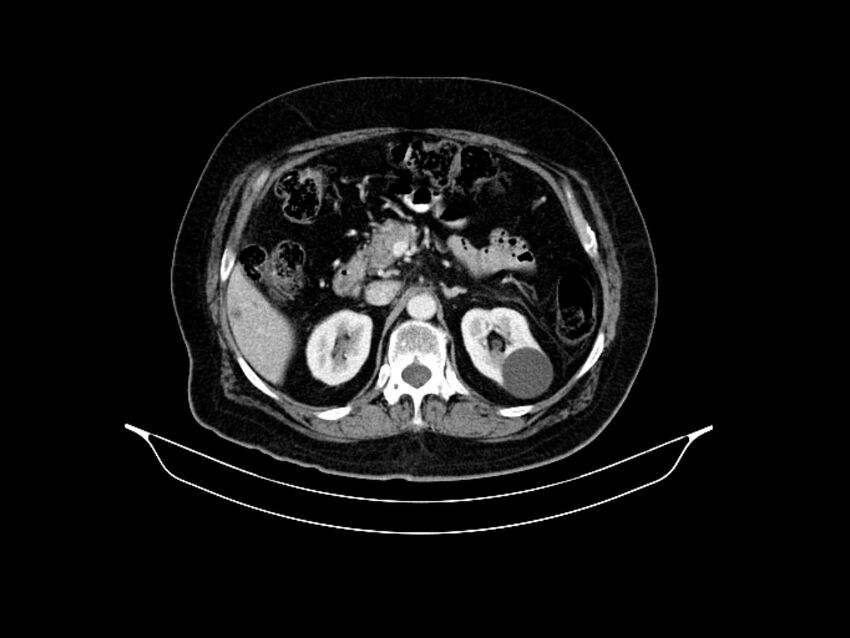 Adenocarcinoma of pancreas with hepatic metastasis (Radiopaedia 64332-73122 Axial C+ portal venous phase 75).jpg