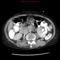 Adenocarcinoma of the colon (Radiopaedia 8191-9039 Axial renal excretory phase 21).jpg
