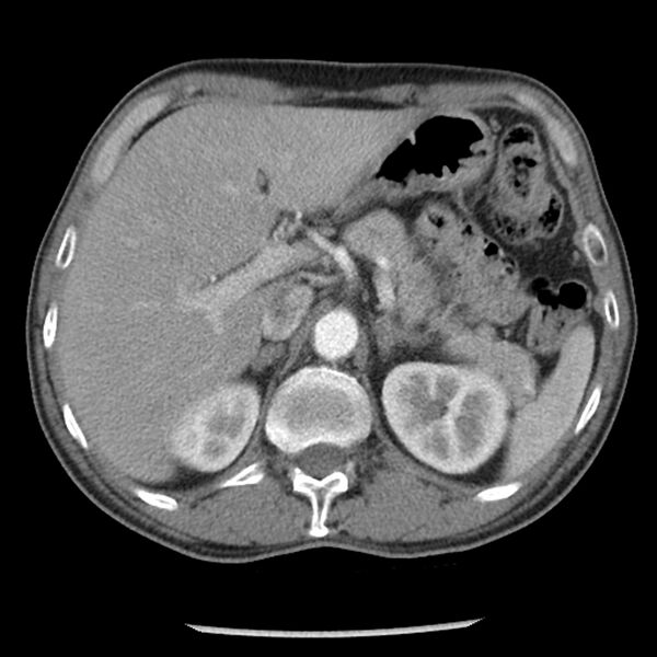 File:Adenocarcinoma of the lung - micropapillary predominant (Radiopaedia 42446-45563 Axial C+ portal venous phase 74).jpg