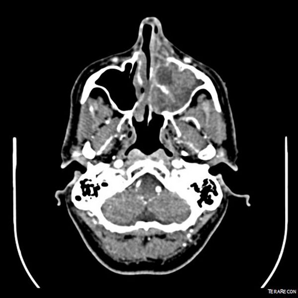 File:Adenoid cystic carcinoma involving paranasal sinus (Radiopaedia 16580-16283 Axial C+ arterial phase 5).jpeg