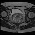 Adenoma malignum of the cervix (Radiopaedia 24460-24765 C 17).jpg