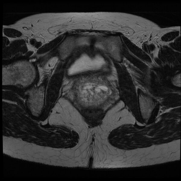 File:Adenoma malignum of the cervix (Radiopaedia 24460-24765 C 22).jpg