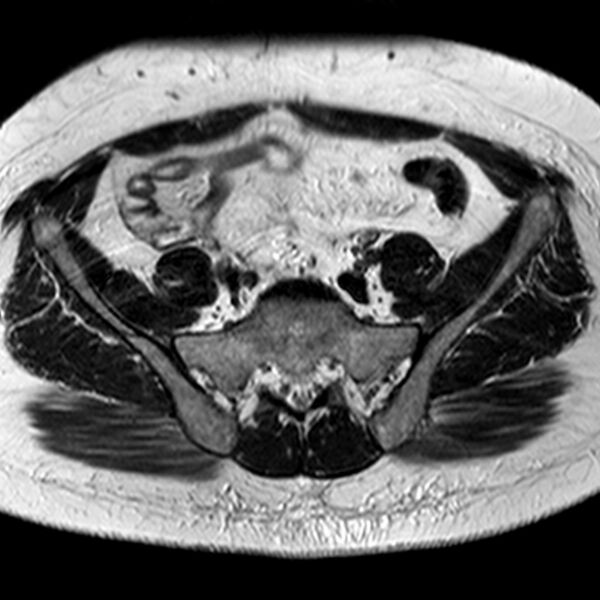 File:Adenomyoma of the uterus (Radiopaedia 9871-10439 Axial T2 28).jpg
