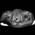 Adenomyoma of the uterus (huge) (Radiopaedia 9870-10438 Axial T1 fat sat 8).jpg