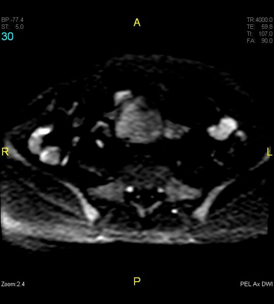File:Adenomyosis (Radiopaedia 43504-46889 Axial DWI 30).jpg