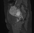 Adenomyosis - ovarian endometriomas (Radiopaedia 67031-76350 Sagittal T1 C+ fat sat 19).jpg