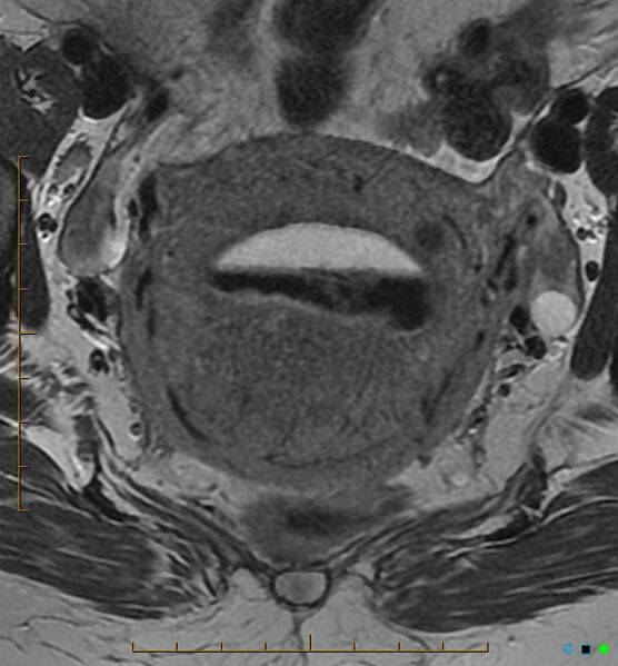 File:Adenomyosis uterus with hematometra (Radiopaedia 45779-50011 Axial T2 16).jpg