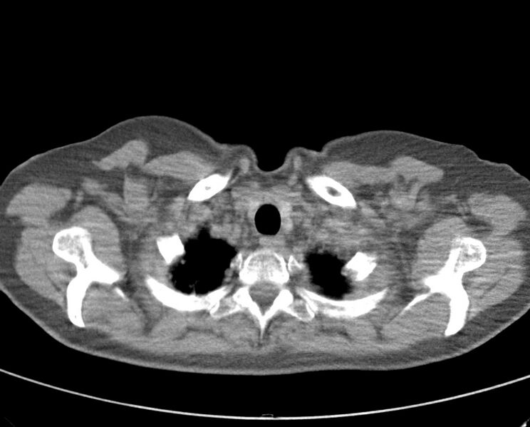 File:Adenosquamous lung carcinoma (Radiopaedia 22035-22030 non-contrast 13).jpg