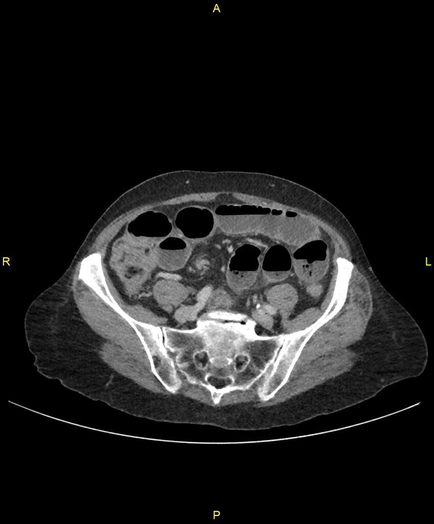 Adhesional small bowel obstruction (Radiopaedia 85402-101024 Axial C+ portal venous phase 203).jpg