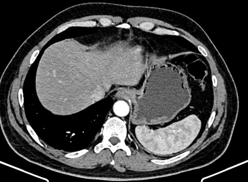 File:Adrenal metastases (Radiopaedia 73082-83791 Axial C+ arterial phase 20).jpg