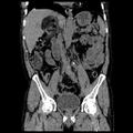 Adrenal myelolipoma (Radiopaedia 41843-44834 Coronal non-contrast 4).jpg