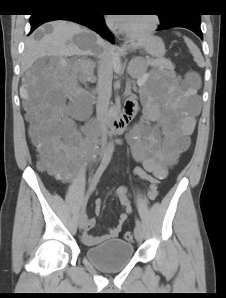File:Adult polycystic kidney disease (Radiopaedia 47866-52626 Coronal non-contrast 23).png
