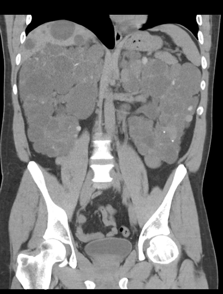 File:Adult polycystic kidney disease (Radiopaedia 47866-52626 Coronal non-contrast 27).png