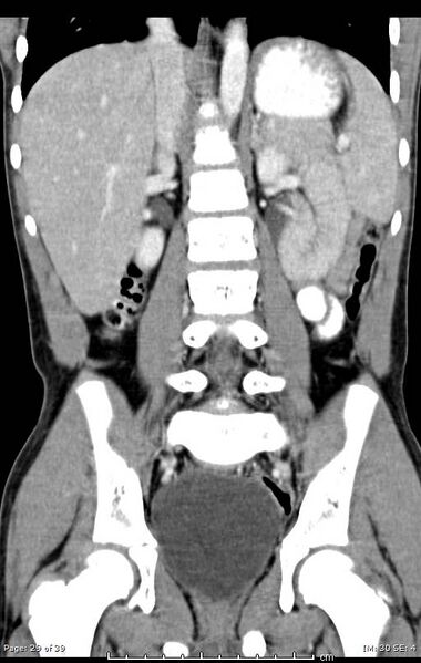 File:Agenesis of the gallbladder (Radiopaedia 55454-61905 A 29).jpg