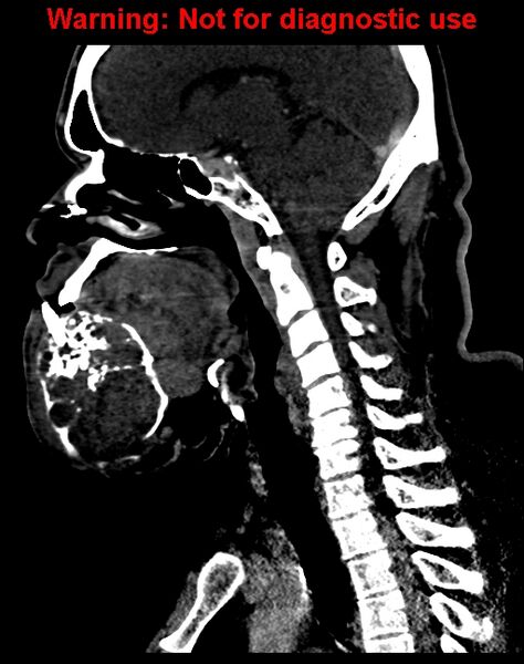 File:Ameloblastoma (Radiopaedia 33126-34164 F 39).jpg