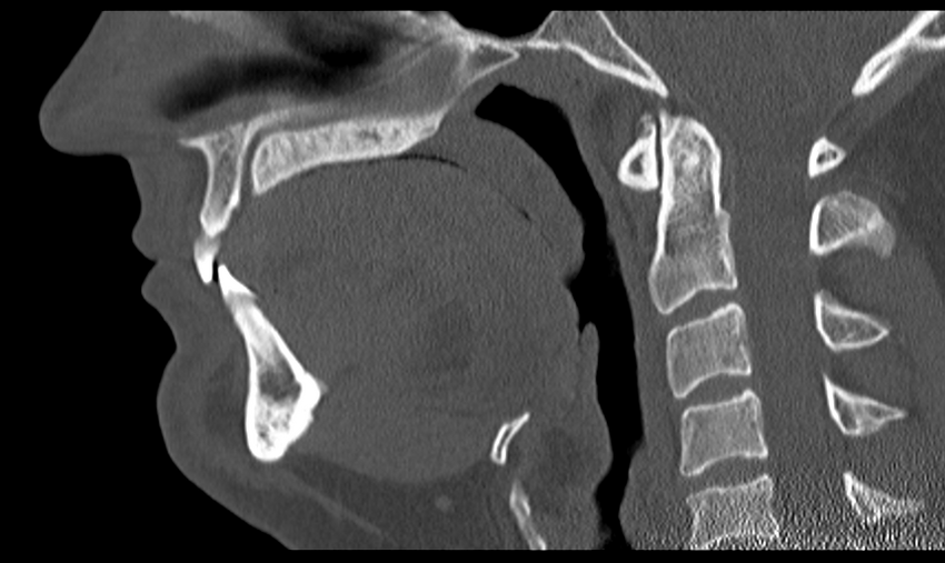 Ameloblastoma (Radiopaedia 33677-34806 Sagittal bone window 33).png