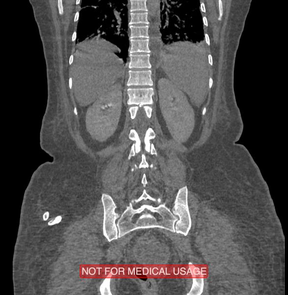 File:Amoebic enterocolitis with liver abscess (Radiopaedia 35100-36609 B 158).jpg