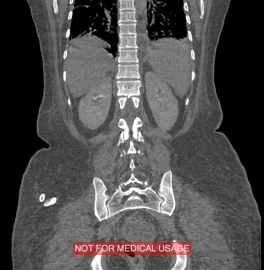 Amoebic enterocolitis with liver abscess (Radiopaedia 35100-36609 B 158).jpg