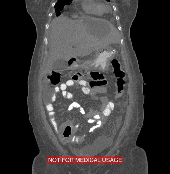 File:Amoebic enterocolitis with liver abscess (Radiopaedia 35100-36609 B 39).jpg