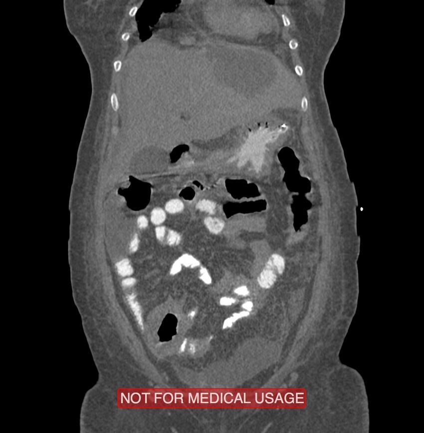 Amoebic enterocolitis with liver abscess (Radiopaedia 35100-36609 B 39).jpg