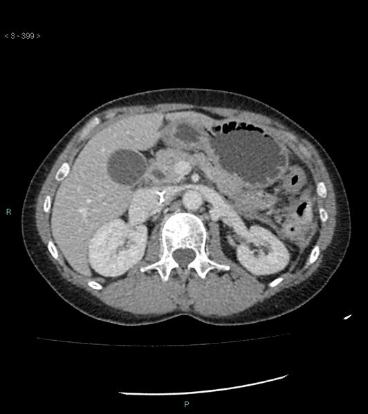 File:Ampulla of Vater metastasis (Radiopaedia 27820-28069 A 37).jpg
