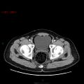 Ampullary carcinoma (Radiopaedia 56396-63056 C 96).jpg