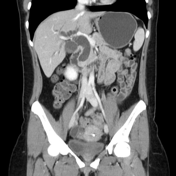 File:Ampullary tumor (Radiopaedia 22787-22816 E 27).jpg