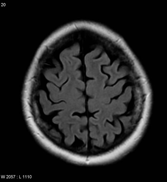File:Amyotrophic lateral sclerosis (Radiopaedia 5373-7134 Axial FLAIR 20).jpg