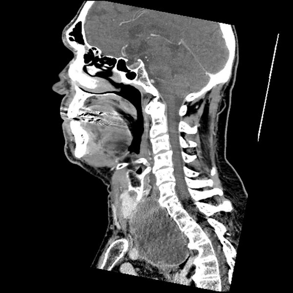 File:Anaplastic thyroid carcinoma (Radiopaedia 79087-92034 C 46).jpg