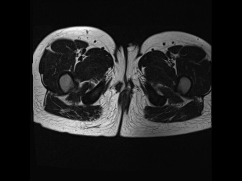 File:Androgen insensitivity syndrome (Radiopaedia 42046-45081 Axial T2 20).jpg