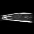 Aneurysmal bone cyst - radius (Radiopaedia 5866-7442 Sagittal T1 1).jpg