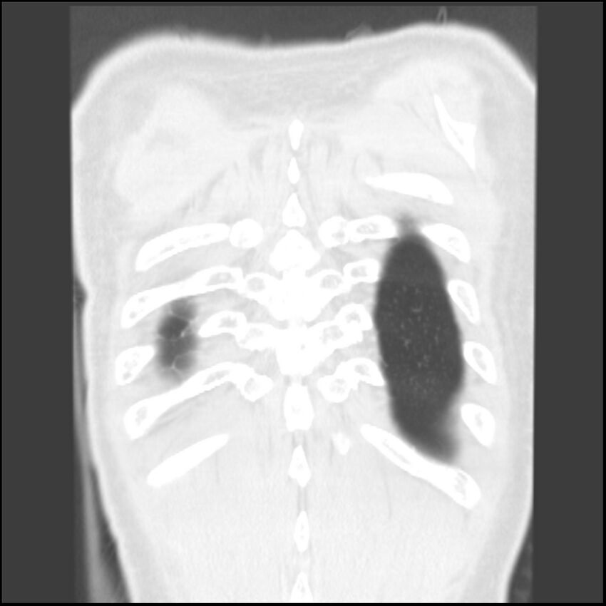 Angioinvasive aspergillosis (Radiopaedia 43957-47466 Coronal lung window 4).jpg