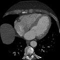 Anomalous origin of left circumflex artery from right coronary sinus (Radiopaedia 72563-83117 B 106).jpg
