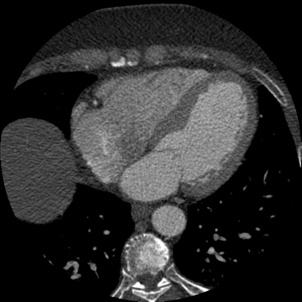 File:Anomalous origin of left circumflex artery from right coronary sinus (Radiopaedia 72563-83117 B 106).jpg